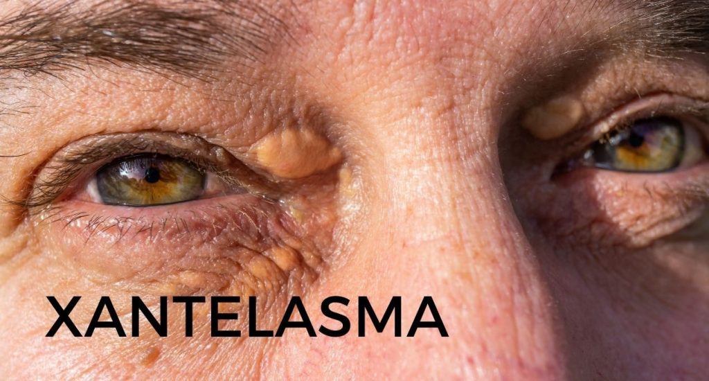 Află ce este xantelasma și cum se tratează