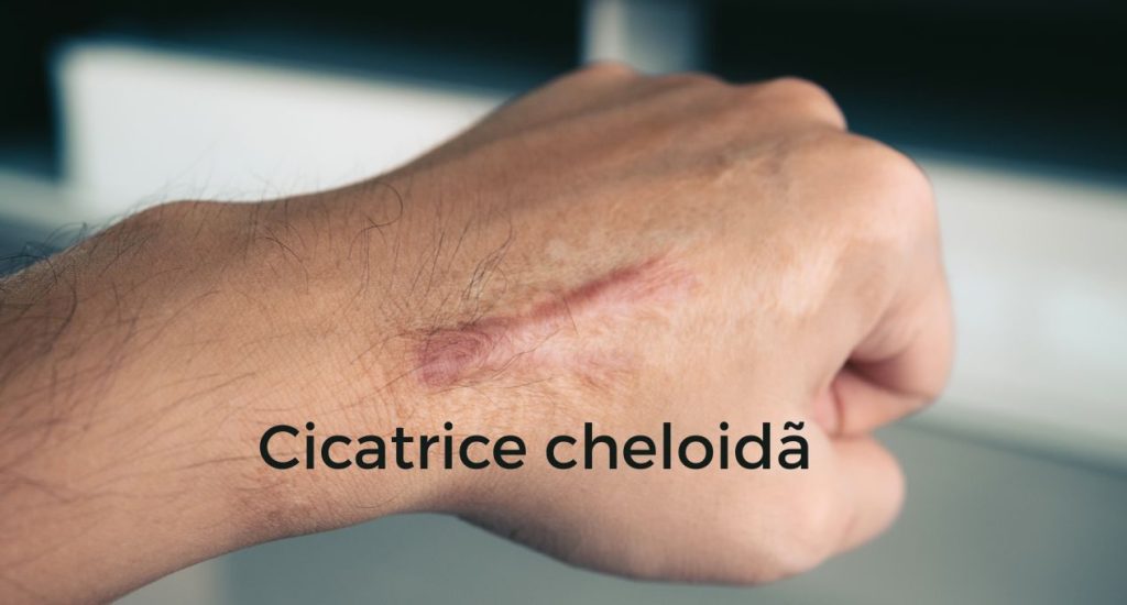 Cicatrice cheloida: de ce apare și cum o poți trata corect